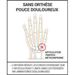 Orthèse de pouce rigide thermoformable | Pouce douloureux et déformé
