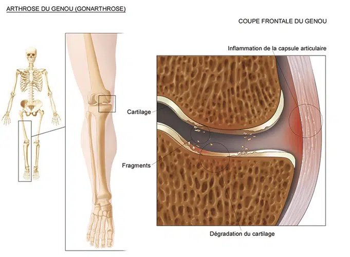 La gonarthrose, l’arthrose du genou
