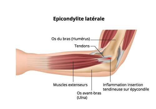 Épicondylite (douleur du coude) : symptômes et cause