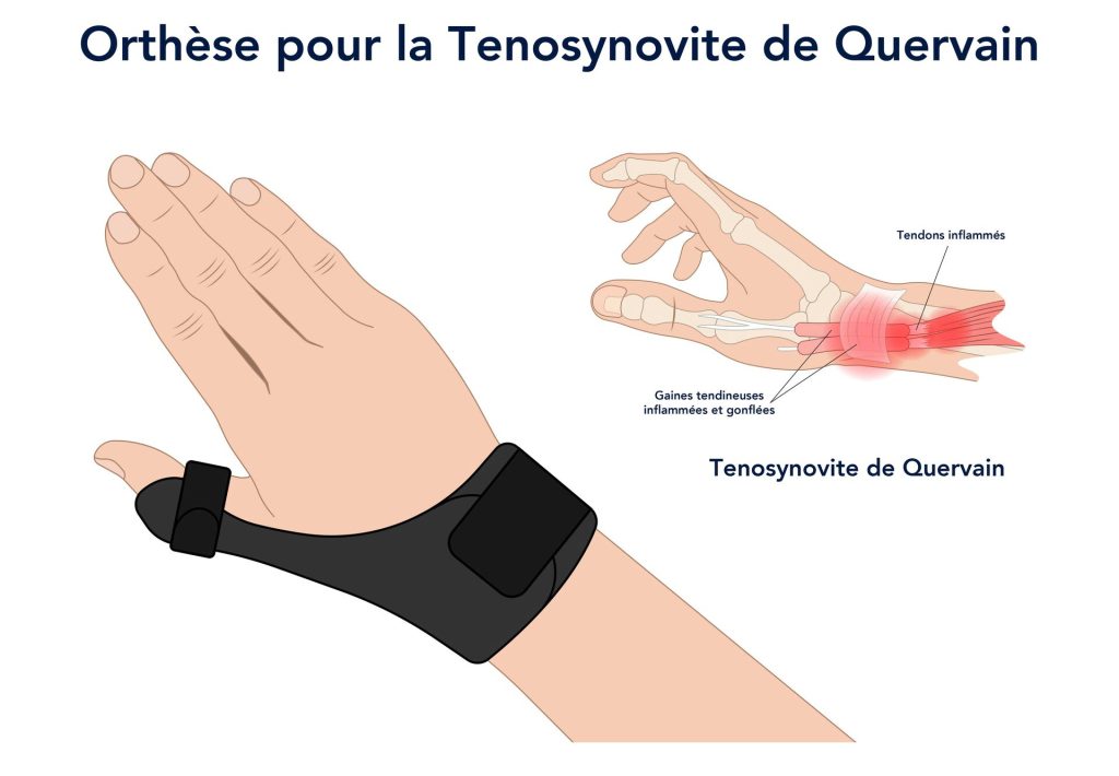 illustration d'une orthèse type pour soulager une ténosynovite de Quervain