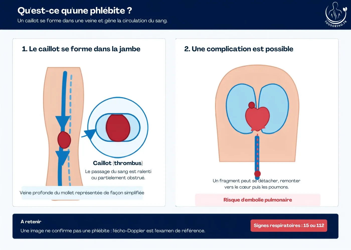 Phlébite : formation du caillot et risque d’embolie pulmonaire Schéma explicatif de la phlébite : formation d’un caillot dans une veine de la jambe et risque d’embolie pulmonaire.